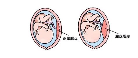 胎盤|胎盘：工作原理以及正常情形